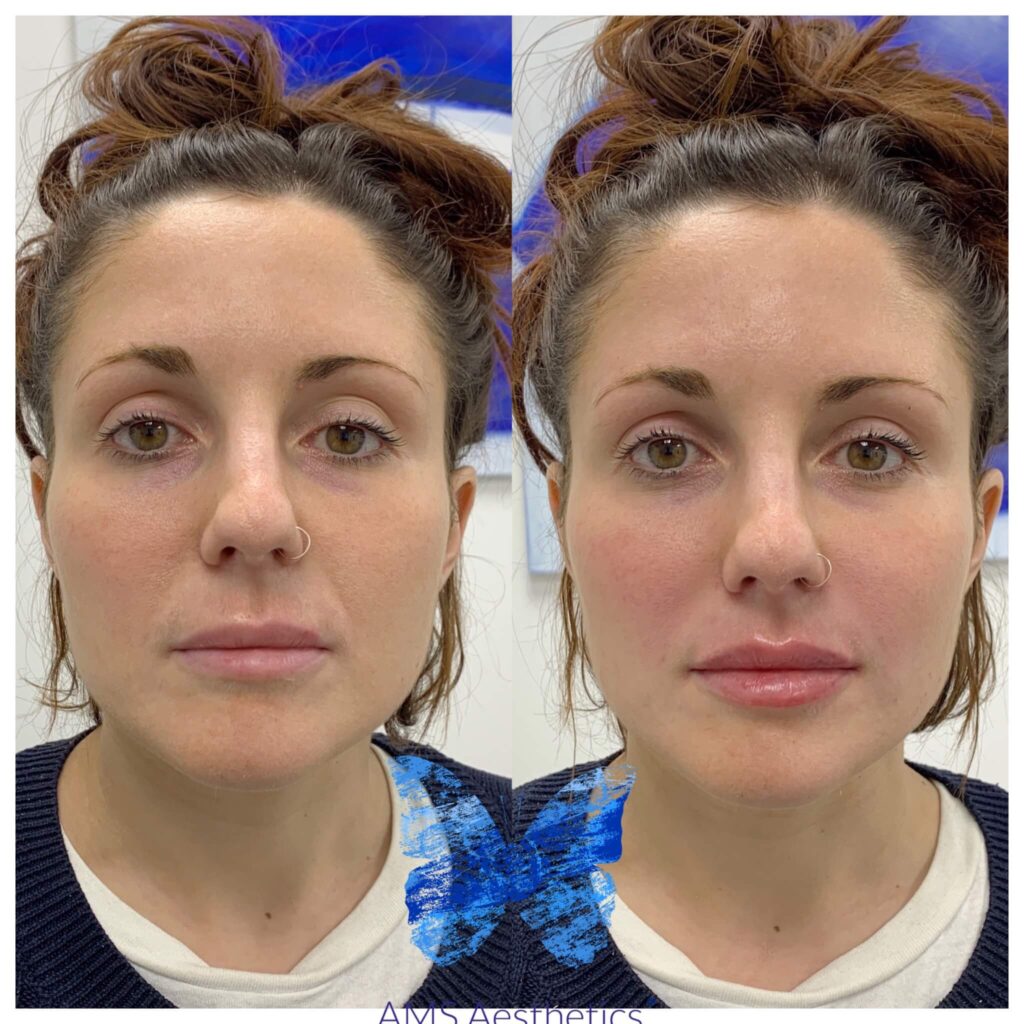 cupids bow lips results