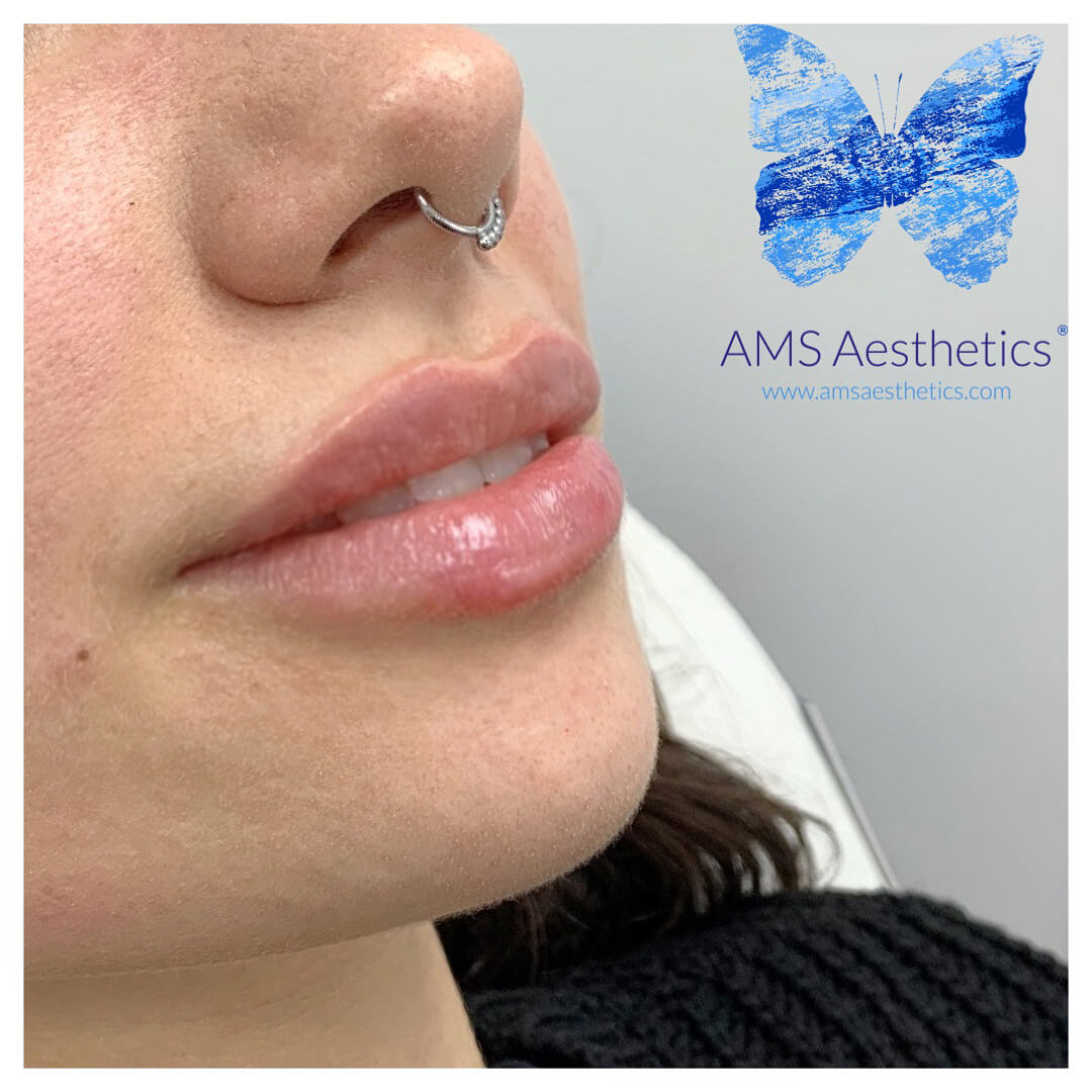 Lip Filler Aftercare For Best Results