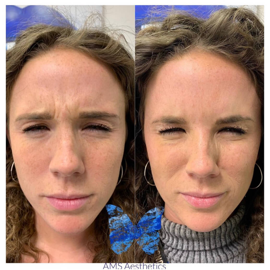Anti Wrinkle Injections Before and After
