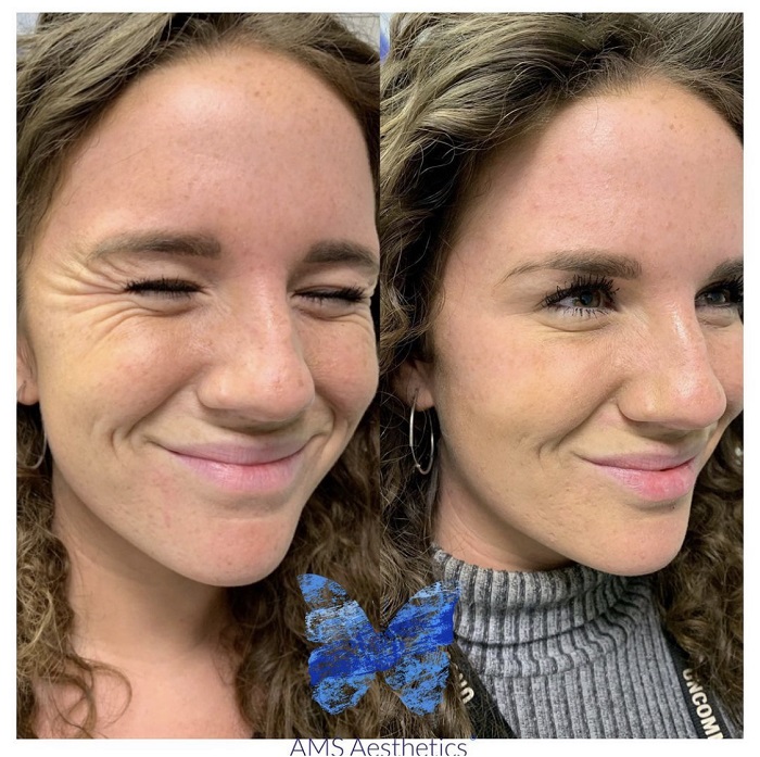 Anti Wrinkle Injections Before and After