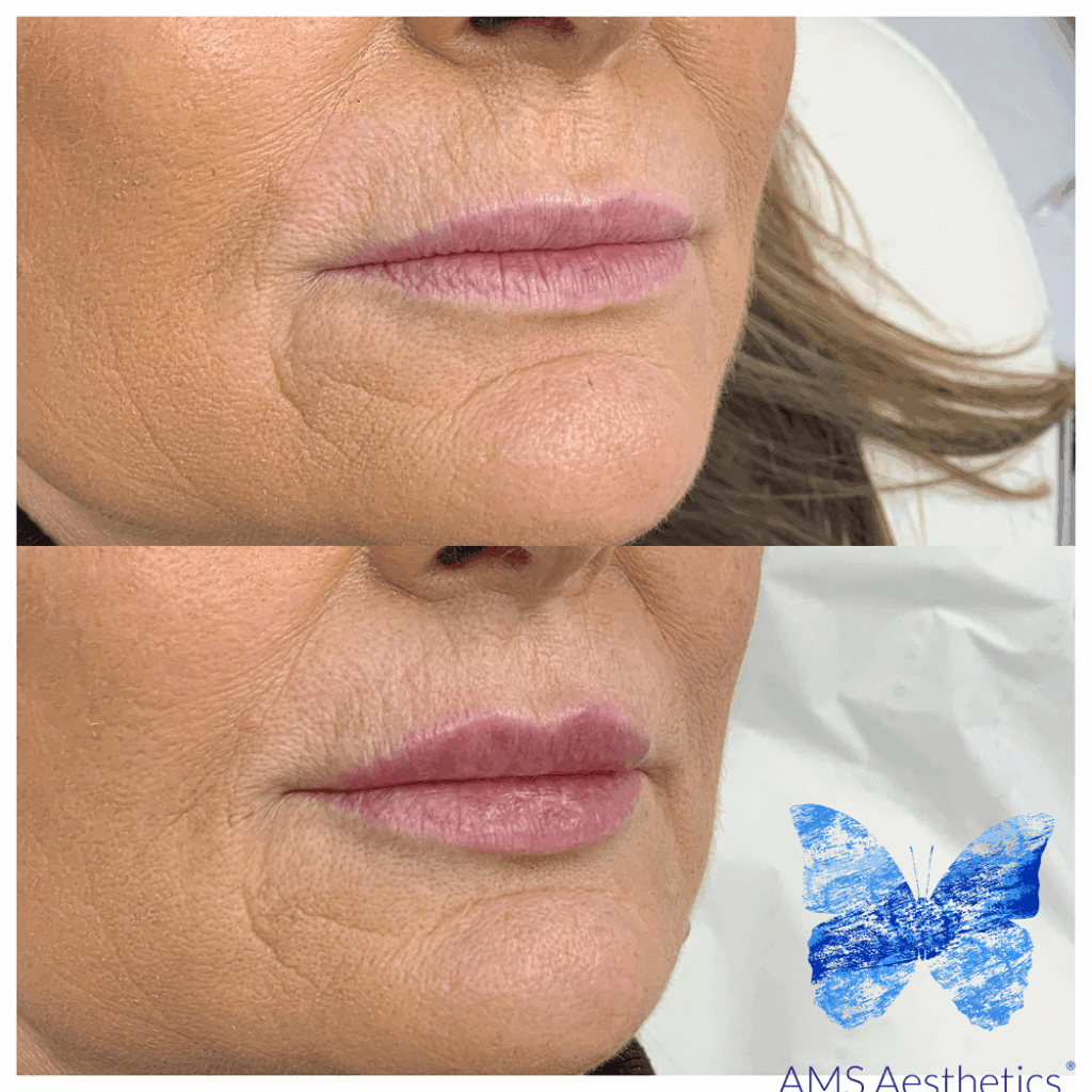 Bigger lips with fillers
