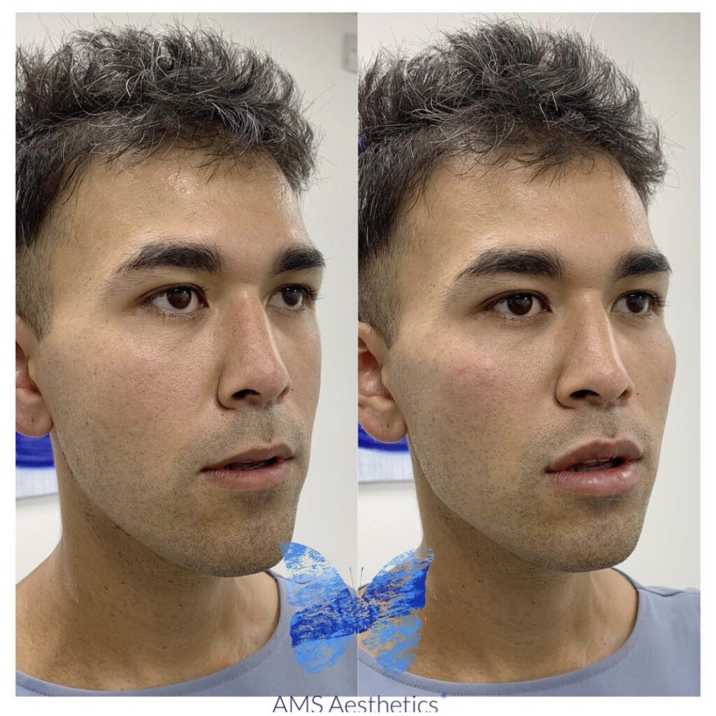 Cheek Fillers Before & After Result