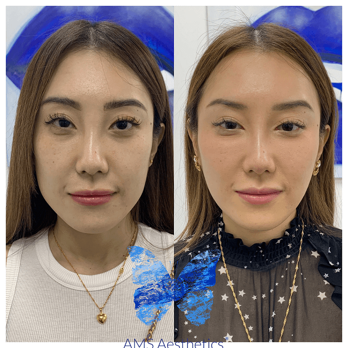 Full Face Rejuvenation before and After
