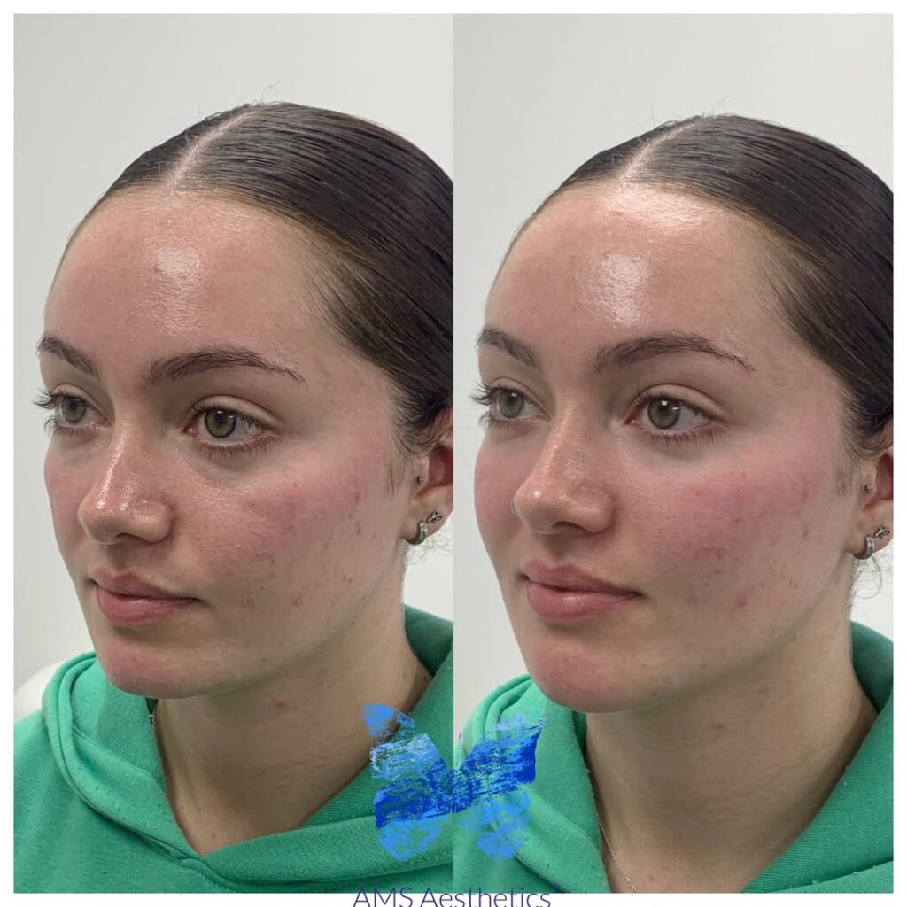 Full face Rejuvenation Results by AMS Aesthetics