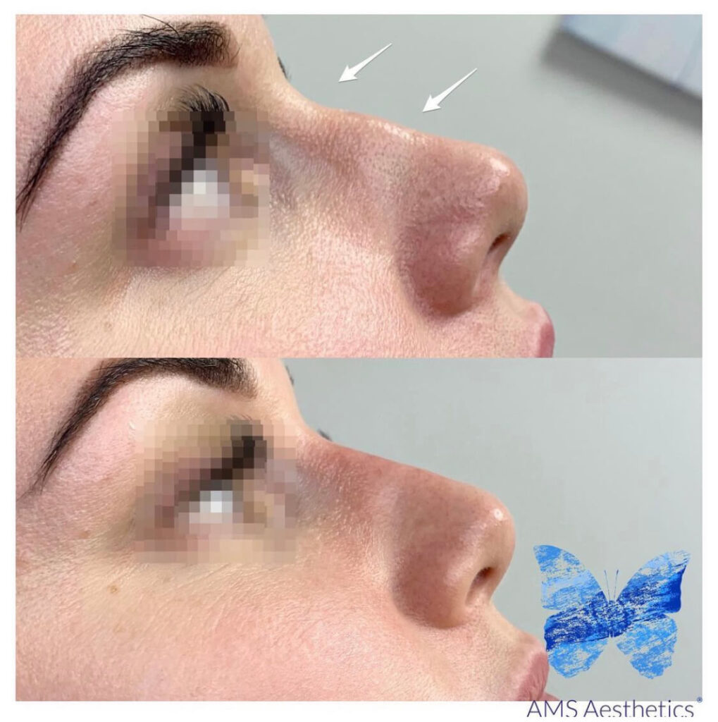 Non Surgical Rhinoplasty