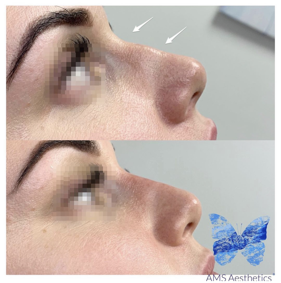 nose filler