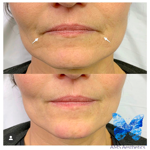 dermal_filler_ba6 1