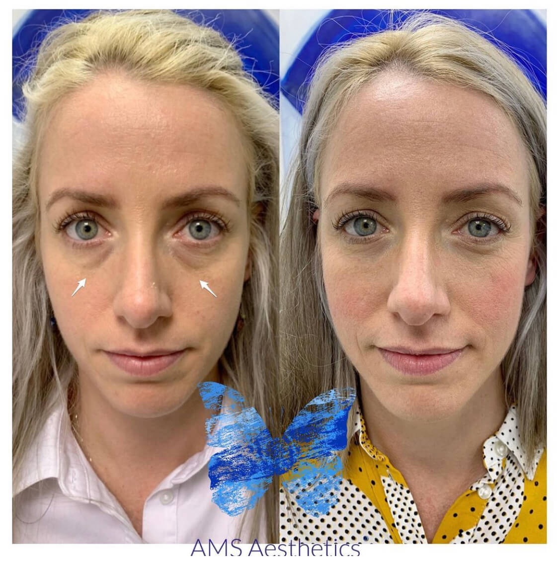 tear trough filler before & after