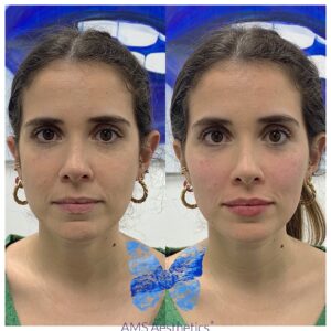 0.5 ml lip filler before and after