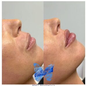 0.7ml lip filler before and after