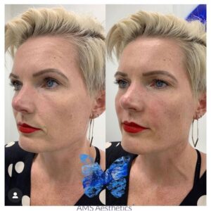 Cheeks contouring Before and after