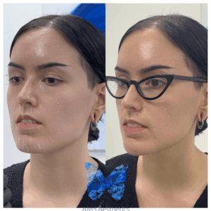 Chin Enhancement before & After