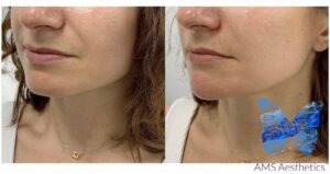 Chin dermal filler results