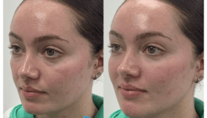 Dermal Fillers Aftercare