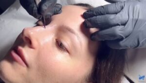 How long does non surgical rhinoplasty last