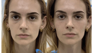 How long do dermal fillers last