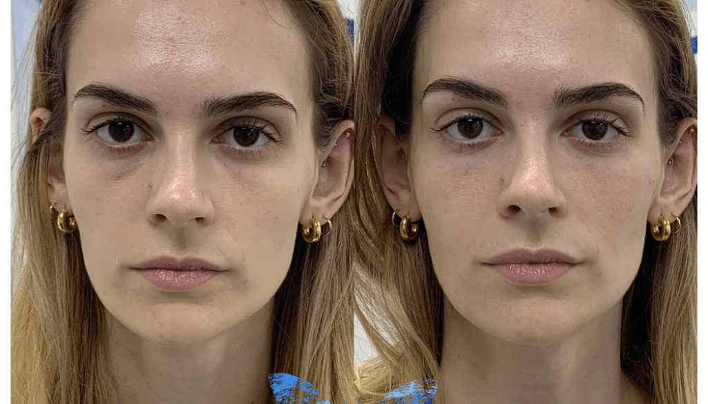 How long do dermal fillers last