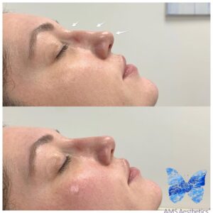 Liquid Non-Surgical Rhinoplasty Before & After Result