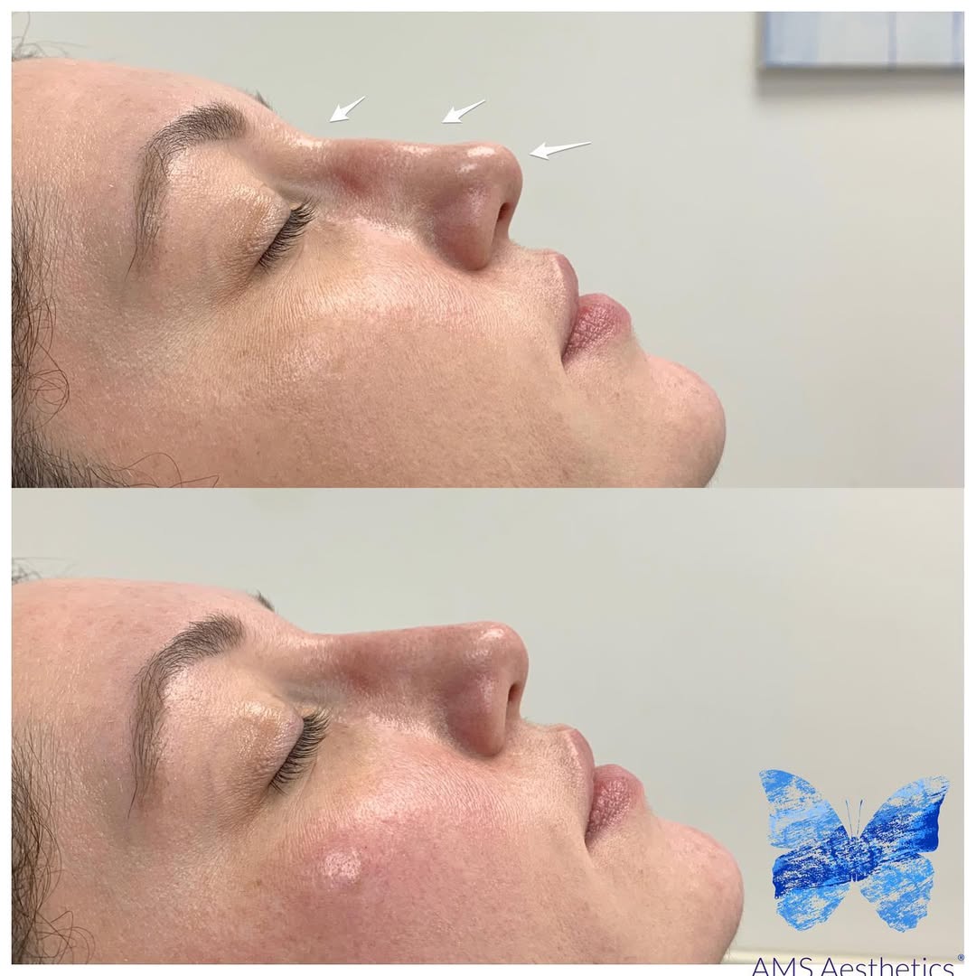 Liquid Non-Surgical Rhinoplasty Before & After Result