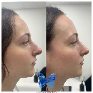 Non-Surgical Rhinoplasty transformation