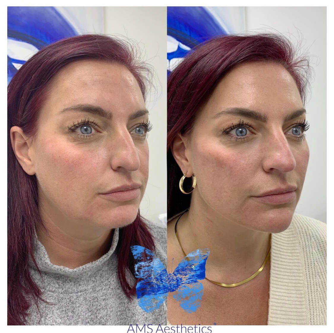 Nose fillers before and after