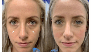 Tear Trough Filler Side effects