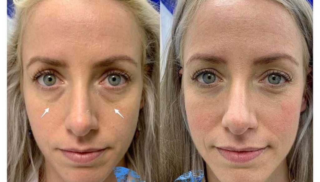 Tear Trough Filler Side effects