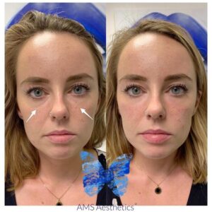 Tear Trough filler before and after