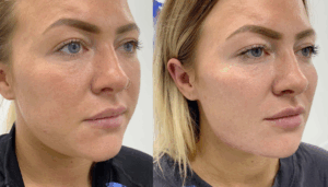 dermal filler before and after