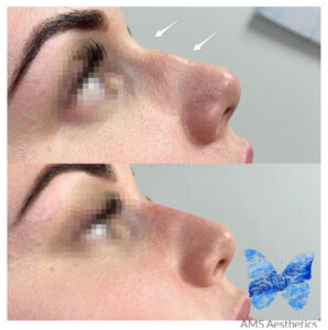nose filler before & after