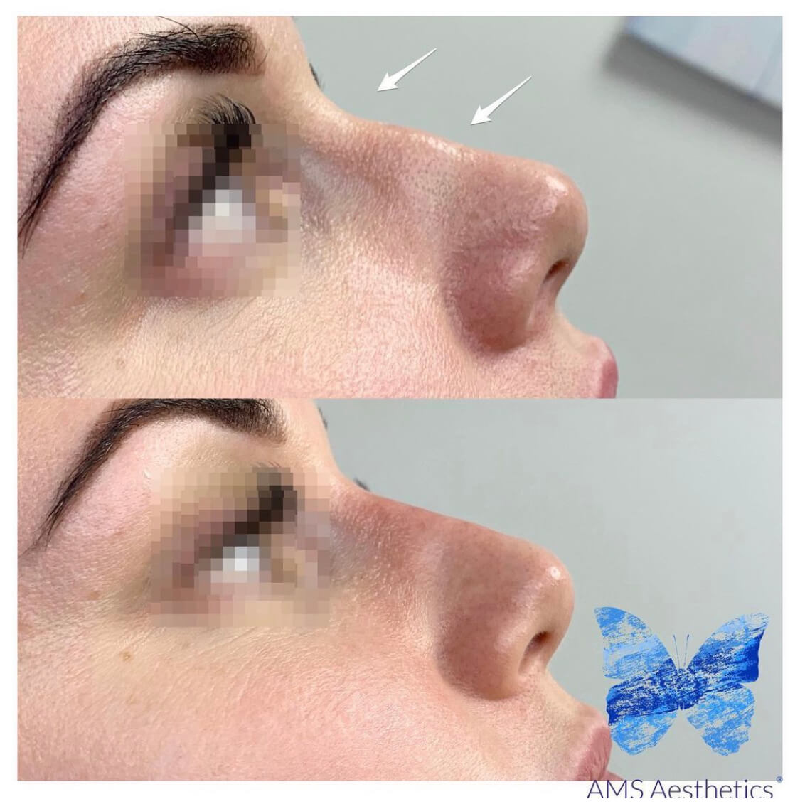 nose filler before & after